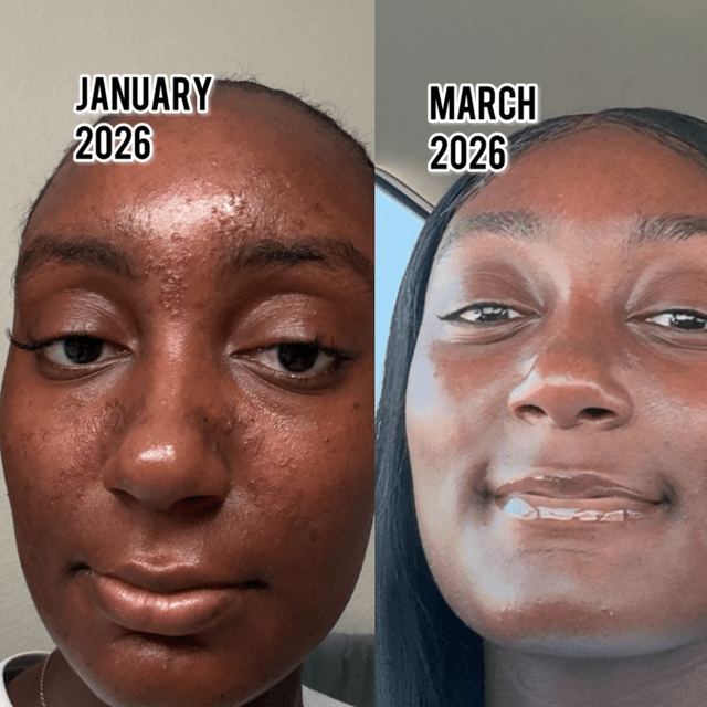 Chemical Peel Package at Loveleighs Skin in Reno, NV